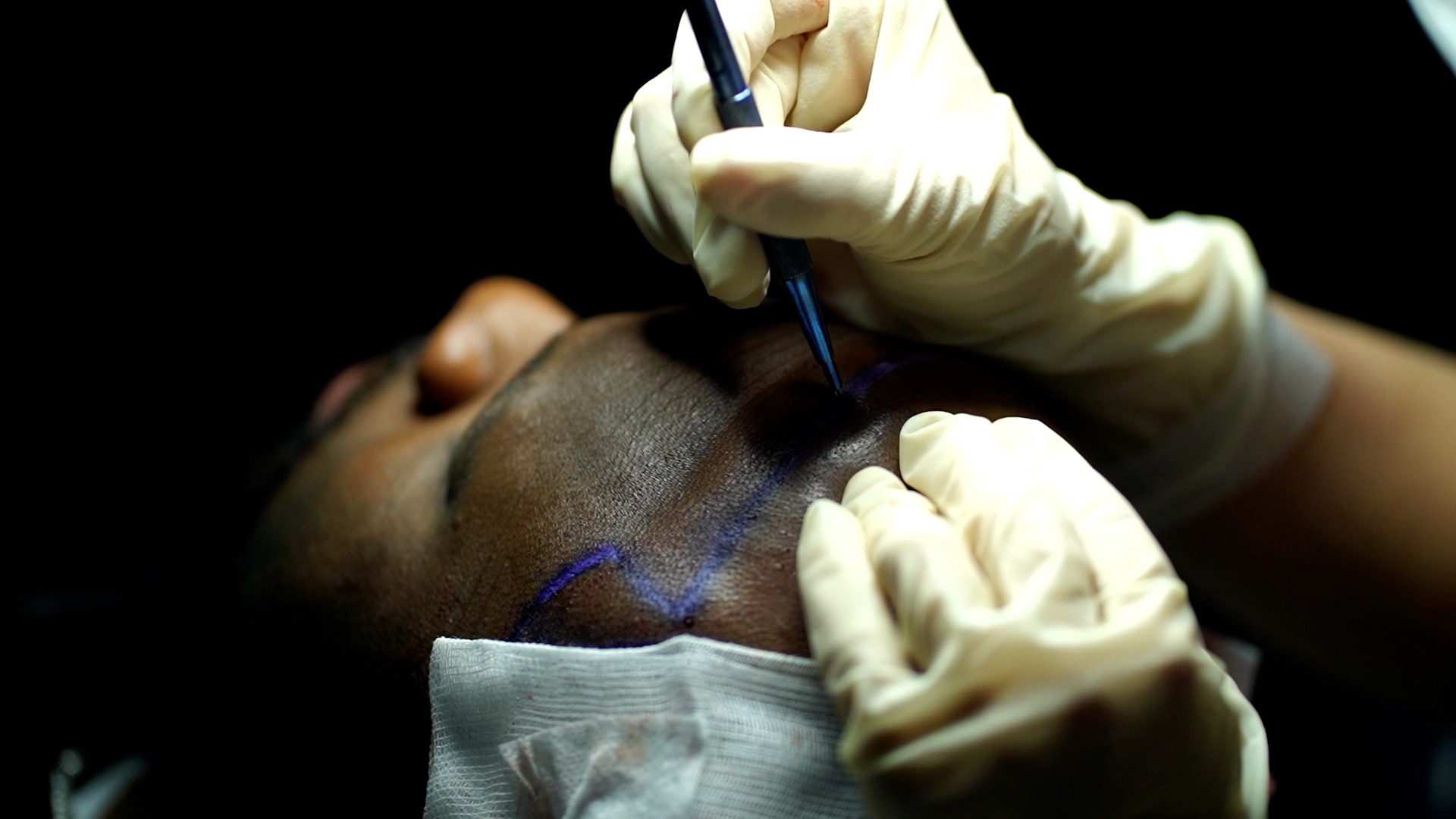 Hair Transplant with Sedation