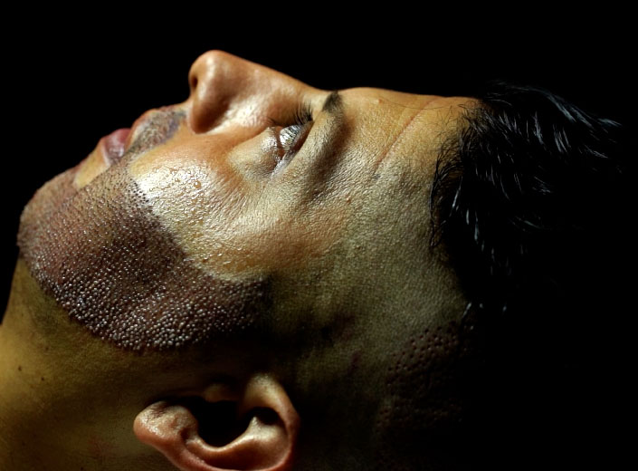 How is Beard Transplantation Applied?