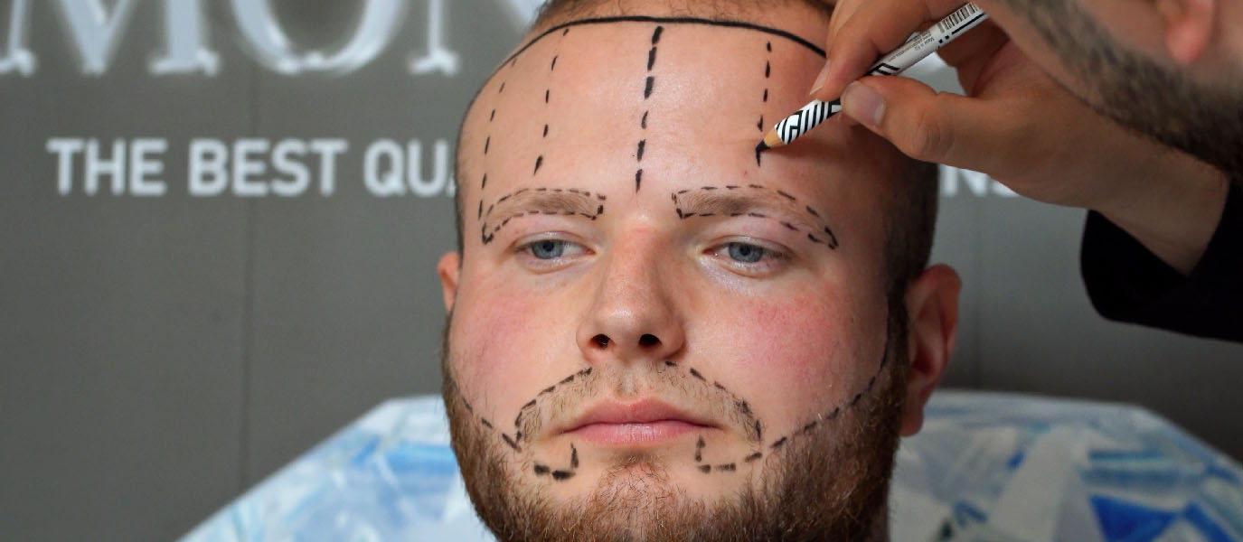 Eyebrow Transplant Turkey