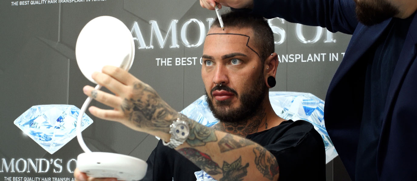 Sapphire FUE Hair Transplant Turkey