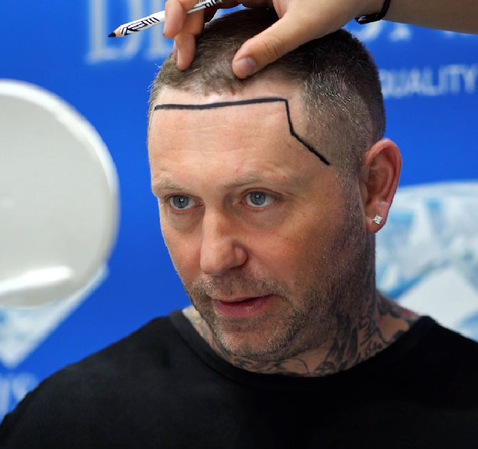 Trapianto di Capelli Sapphire FUE