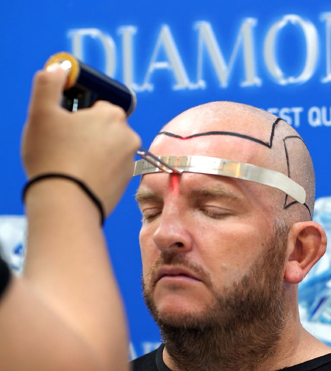 Cos’è il Trapianto di Capelli Sapphire FUE?