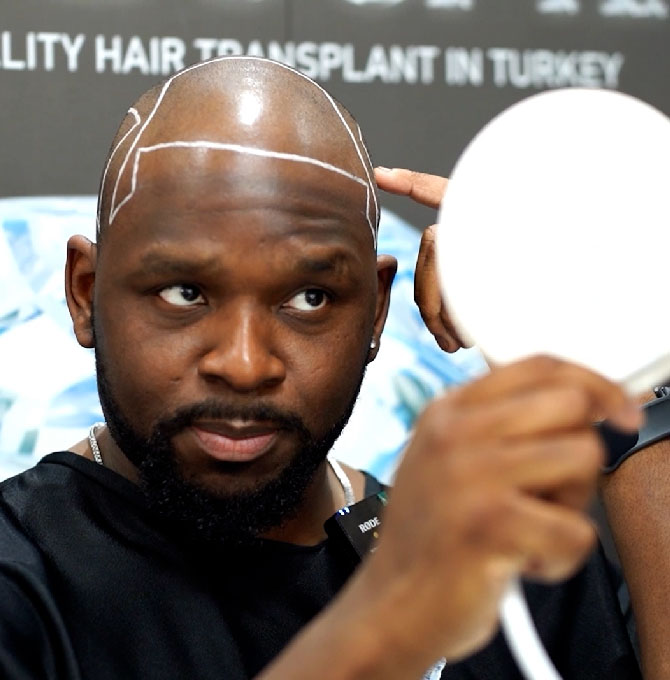How is Sapphire FUE Hair Transplant Done?