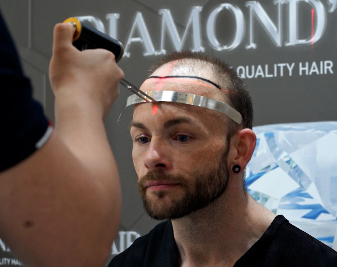 Before Sapphire FUE Hair Transplantation