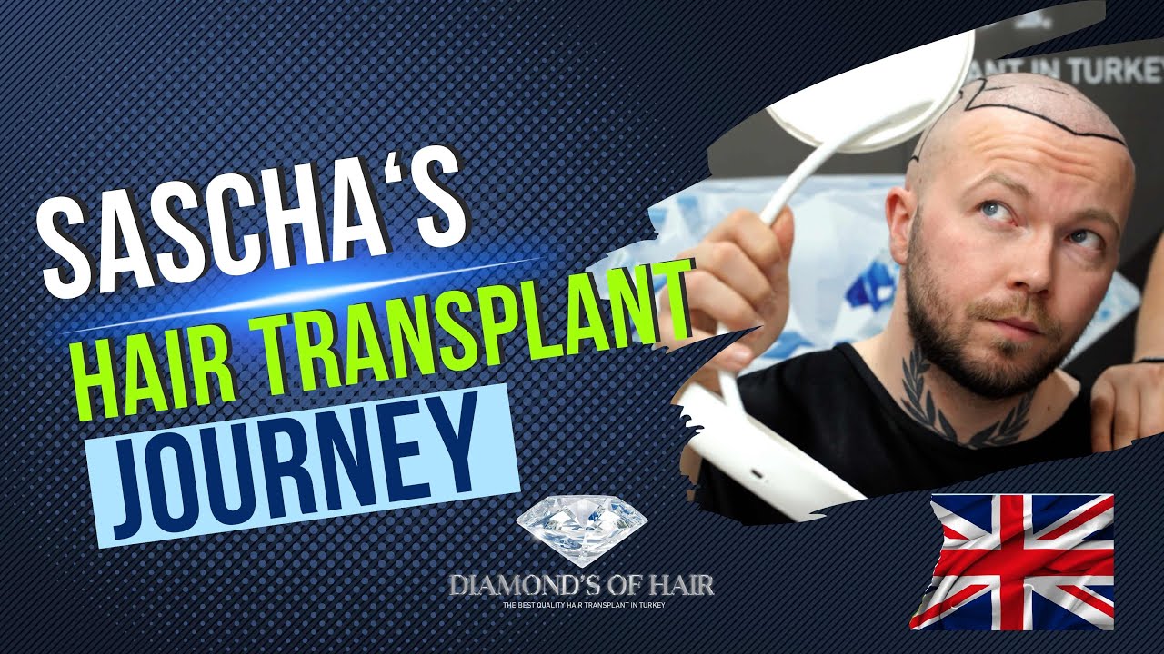 SASCHA'S HAIR TRANSPLANTATION JOURNEY