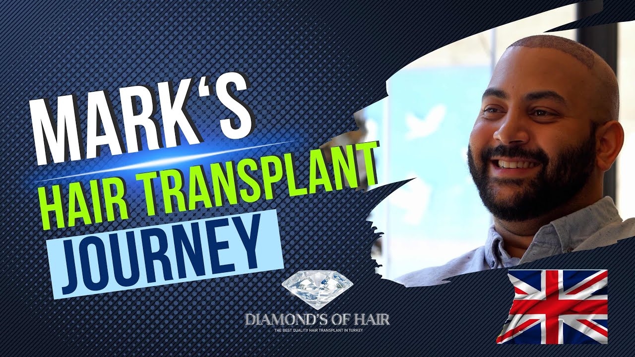 MARK'S HAIR TRANSPLANTATION JOURNEY
