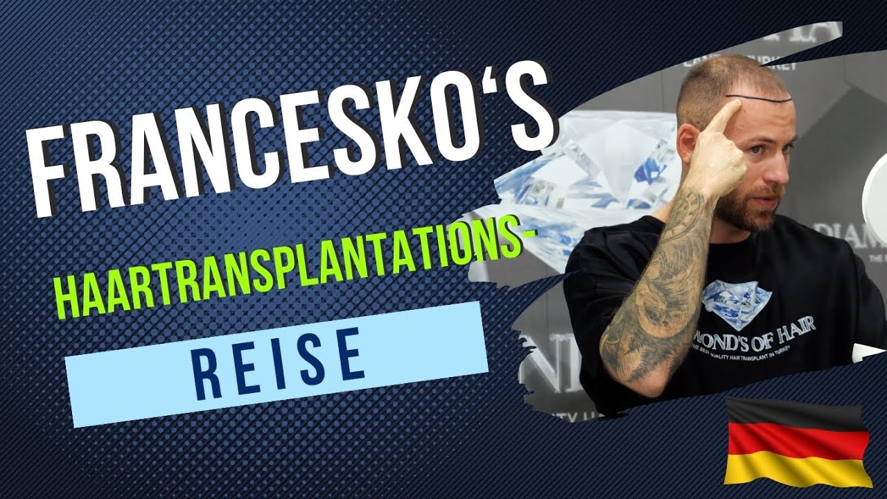 FRANCESKO'S HAARTRANSPLANTATIONS- REISE/AUS DEUTSCHLAND