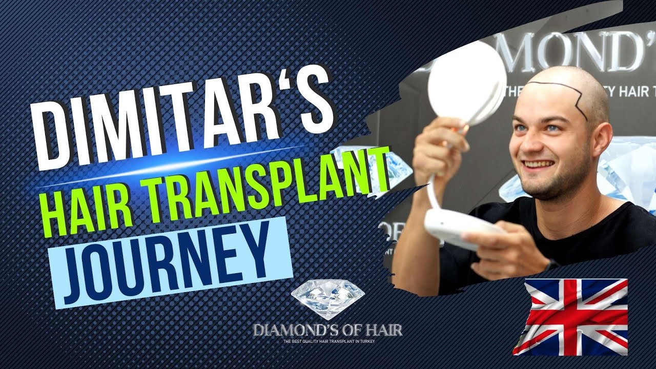 DIMITAR'S HAIR TRANSPLANTATION JOURNEY