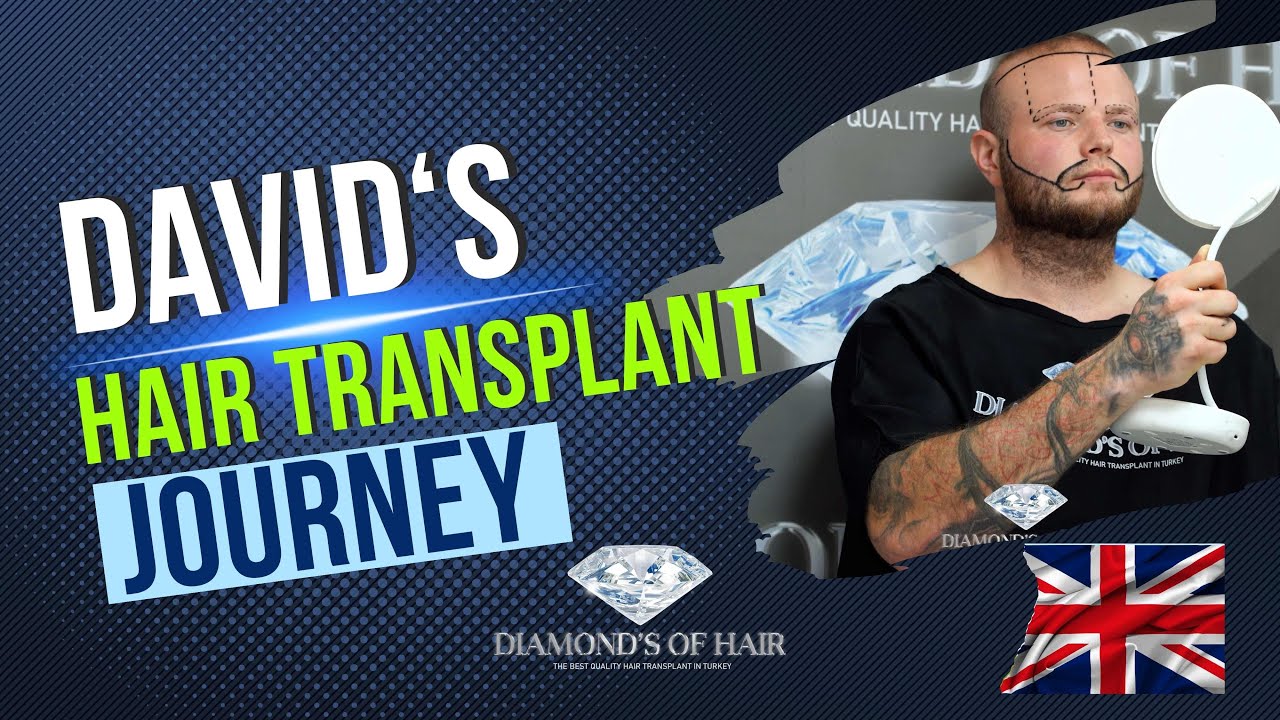 DAVID'S HAIR TRANSPLANTATION JOURNEY