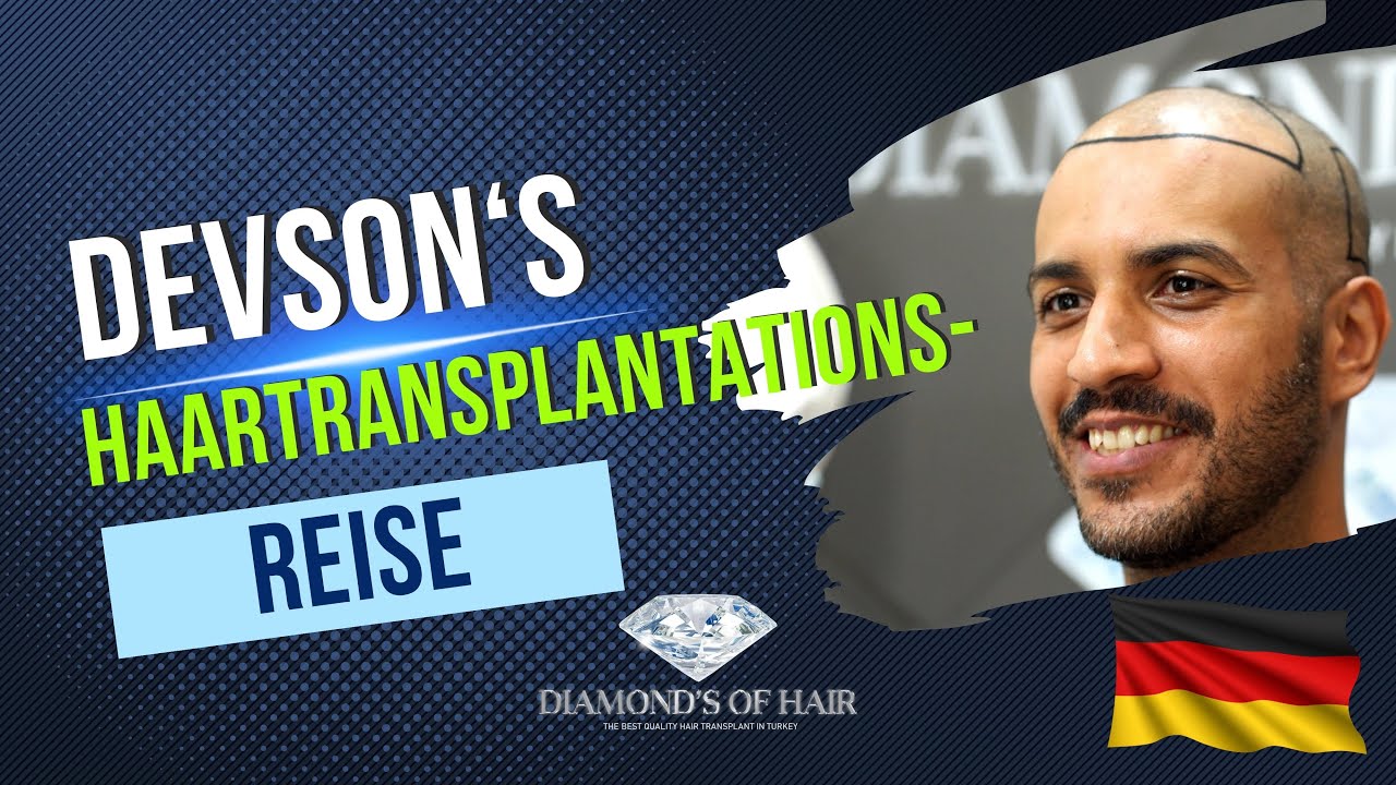 DEVSON'S HAARTRANSPLANTATIONS- REISE/AUS DEUTSCHLAND