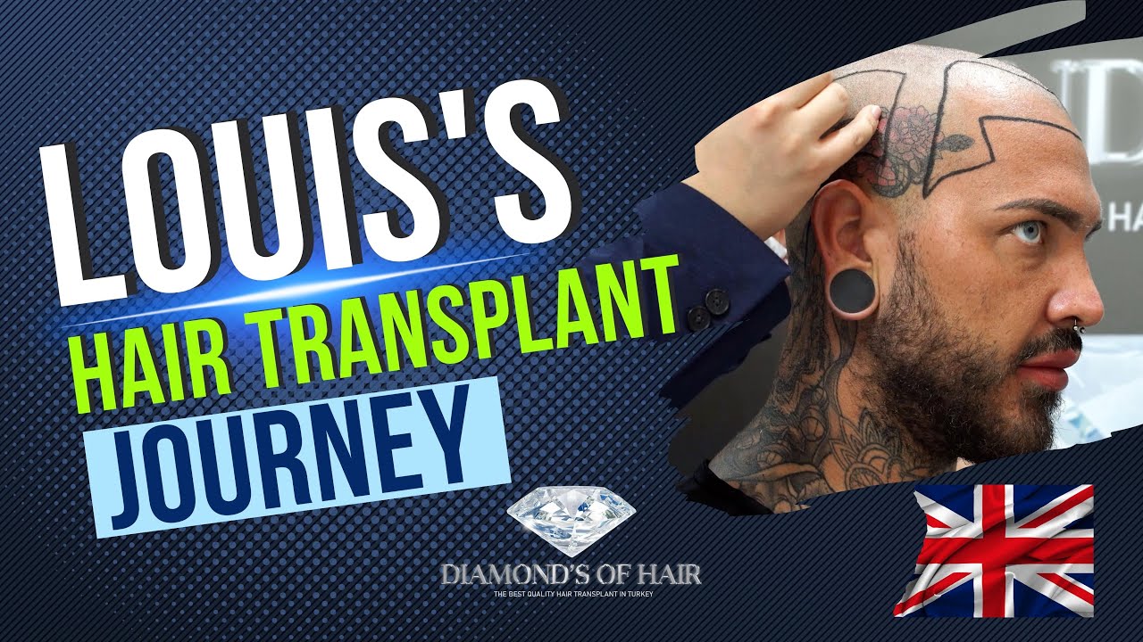 LOUIS'S HAIR TRANSPLANTATION JOURNEY